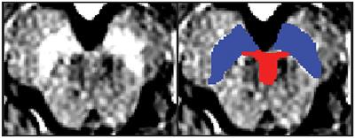 Anatomical Templates of the Midbrain Ventral Tegmental Area and Substantia Nigra for Asian Populations